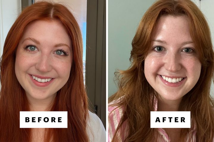 Getting Jawline Injections Left Me With a Distorted Smile